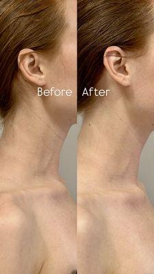 Before and after results after just ONE treatment