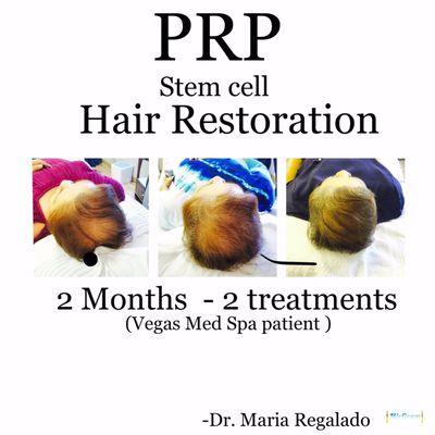 PRP - Hair restoration. Real patient Real results. 2 month treatment