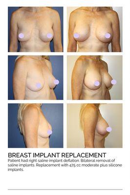 Breast Implant Replacement