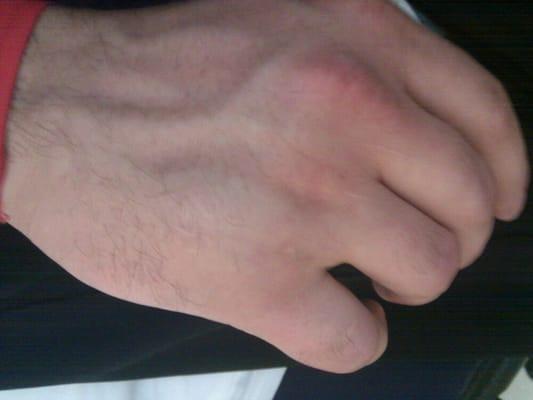 Broke my pinky :(