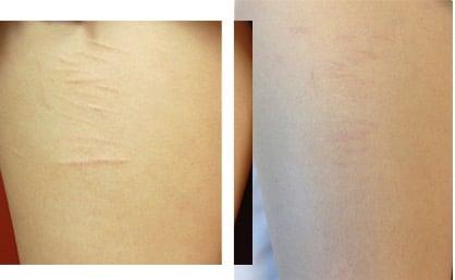 Laser Scar Removal