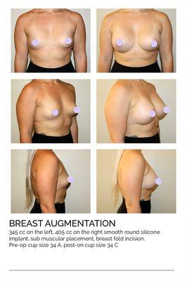 Breast Augmentation