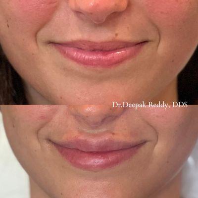 Before and After - Lip Filler