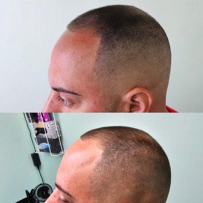 Scalp micro-pigmentation