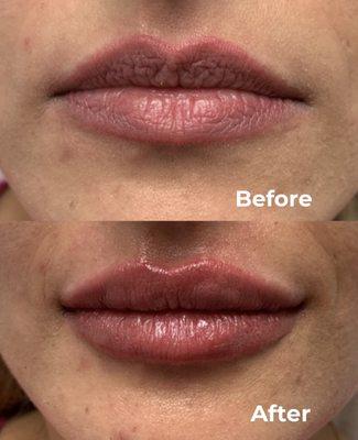 Before and After Lip Augmentation using 0.7cc of Juvederm Ultra Plus XC