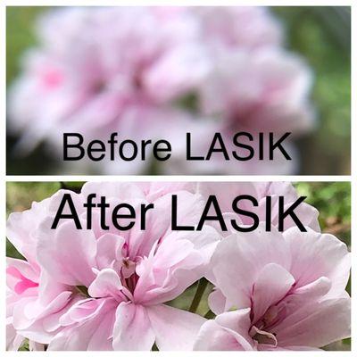 LASIK vision correction