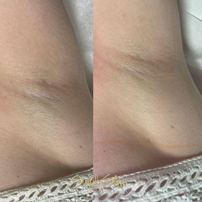 Laser Hair Removal Before/After 1 Treatment