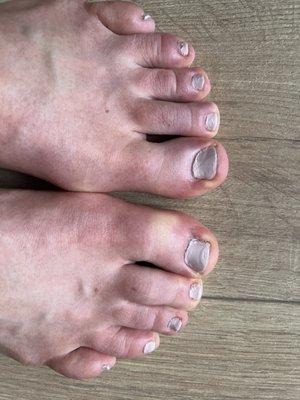 Poor pedicure