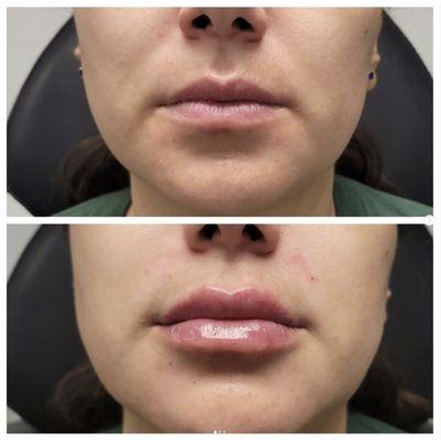 Before and after lip filler using Restylane Kysse.