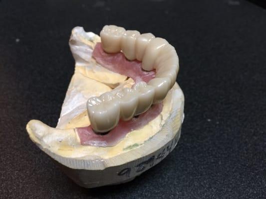 Final zirconia bridge over 6 implants is ready to be delivered