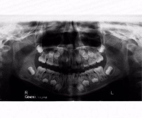 Mixed dentition stage.