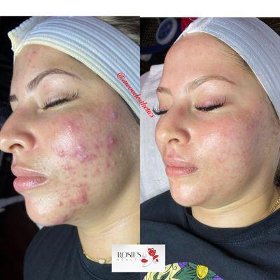 Before and after of a series of acne treatments