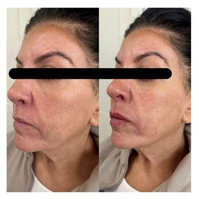 Botox, Filler (cheeks, chin, jaw, and lips)