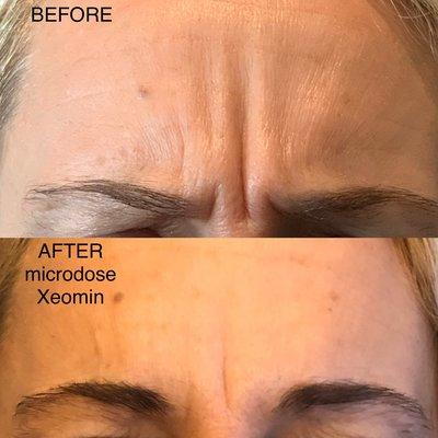 Refreshed face!! Softened worry lines with muscle mapping and microdose Xeomin. A more natural look without a frozen face!