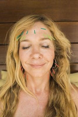 Bring a natural glow to your skin, reduce age lines and increase elasticity with facial rejuvenation acupuncture