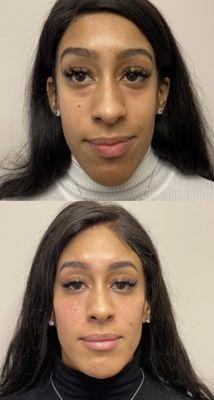 Full facial rejuvenation through dermal fillers.