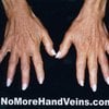 hand veins after vein treatment