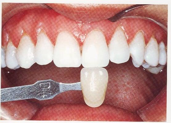 After Teeth Bleaching