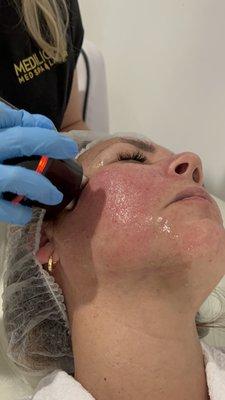 Face Lift treatment: Trilift