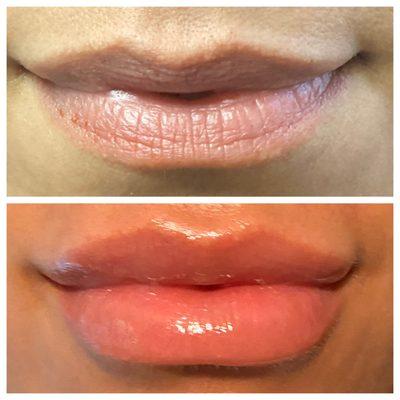 Lip augmentation using fat transfer