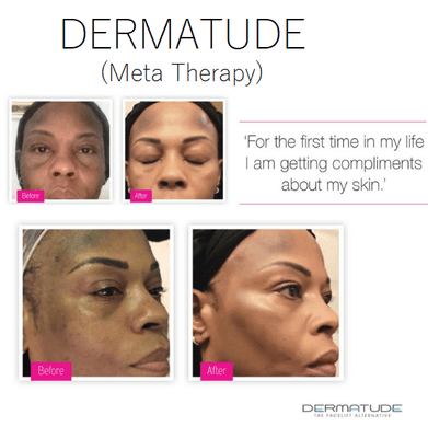 Dermatude activates the production of elastin and collagen, resulting in firmer and lifted, smoother, healthier, even toned looking skin.