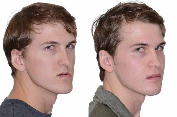 Corrective Jaw Surgery Results