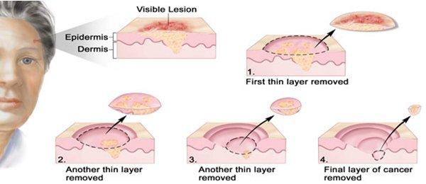 The process of Mohs Micrographic Surgery