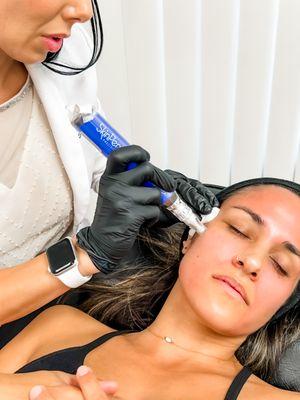 Best Microneedling on the market - SkinPen Microneedling.