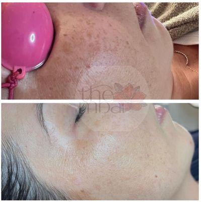 Laser facial results