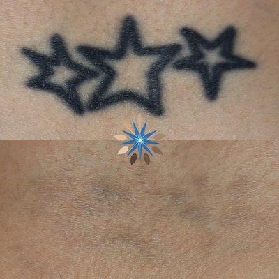 Laser Tattoo Removal