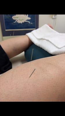 Acupuncture with Frequency Specific Microcurrent