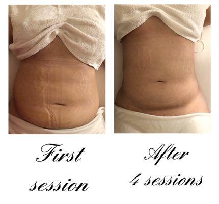 Liposuction massages lymphatic drainage post-op.