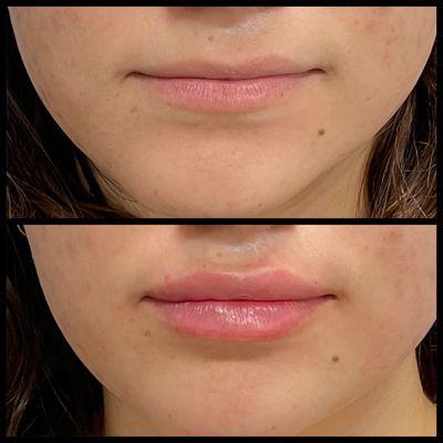 Before an after lip filler