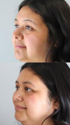 Under eye filler before and after