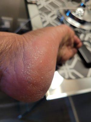 Cheese grater used on heels and this is how they look even with paraffin wax. The grater weren't used correctly