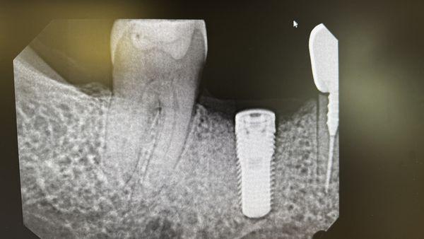 Success. Look how well placed and precise the implant is.