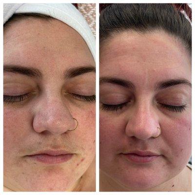 Punkin Plus Facial- 1st visit