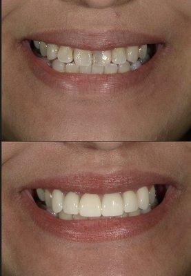 Before and after using 6 veneers great natural result only in a few days