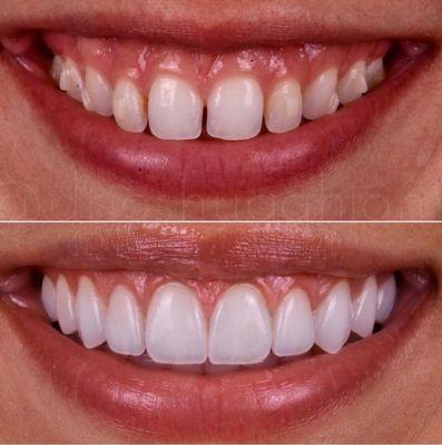 Laser gum lift and porcelain veneers