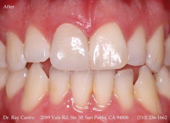 (after) Improving the color of a tooth with new dental materials. This is an actual patient of Dr. Castro.