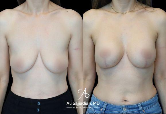 Before and After | Breast Augmentation and Lift