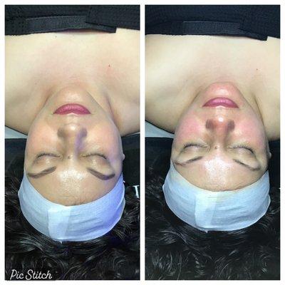 Before and after a Hydrafacial... look at that GLOW!!