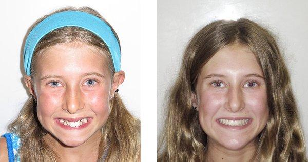 Braces Before and After Transformation Picture! Clear Braces. Damon Braces. Metal Braces. Invisalign.