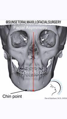 Correction of facial asymmetry