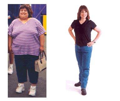 Lisa's before and after revision from another weight loss surgery to Duodenal Switch