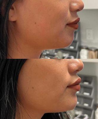 Chin filler for facial balancing. Individual results may vary.