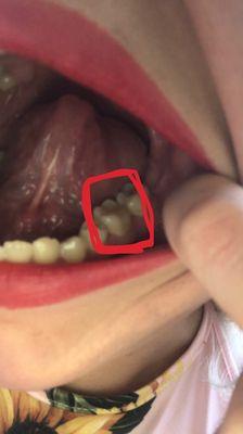 Tooth after Dr. Kim! Saved my tooth without a root canal