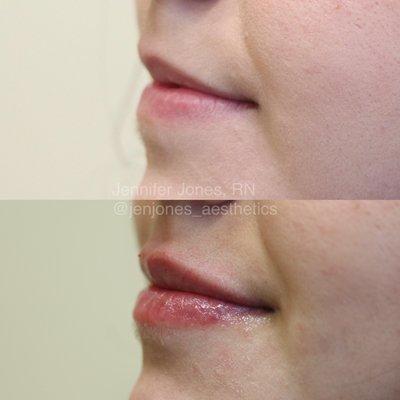 Lip filler before and after