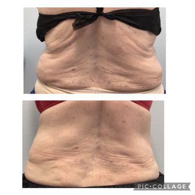 Before and After CoolSculpting Elite: Not only fat reduction but also contouring of the body and skin retraction.