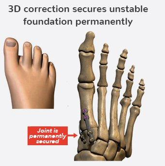 Lapiplasty Bunion Correction